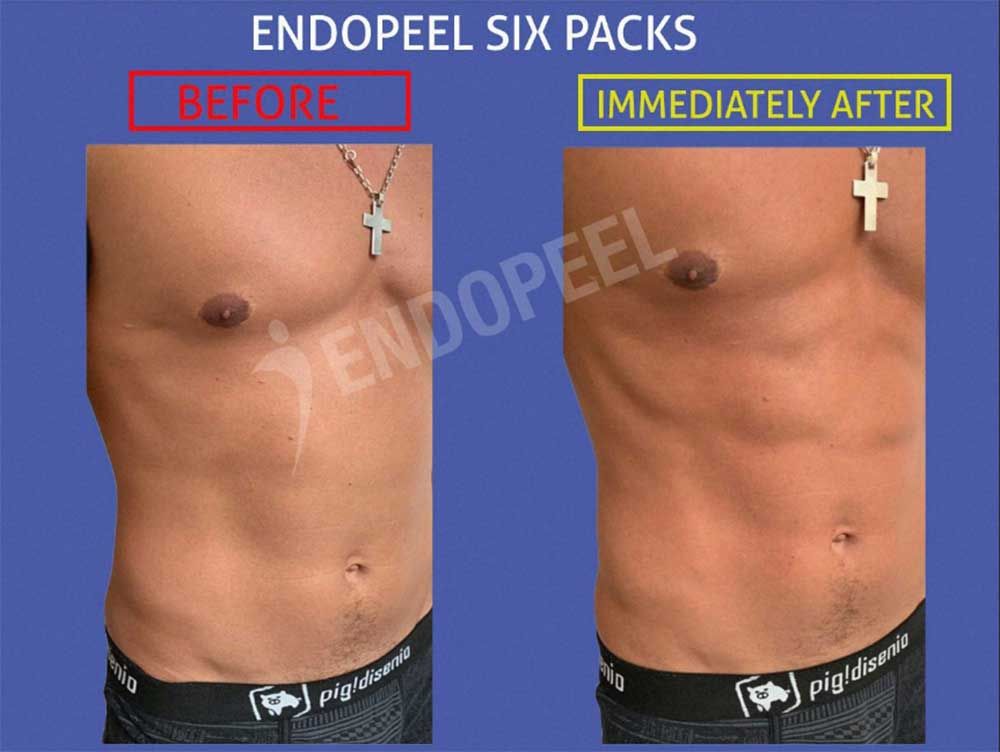 six packs endopeel