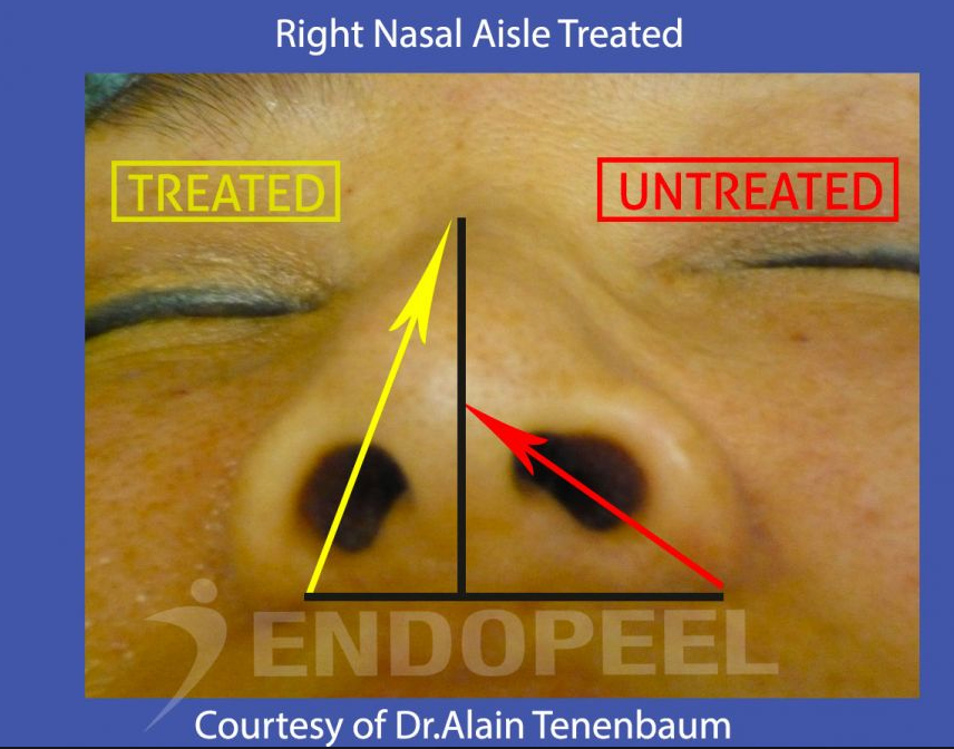 nasal-aisles-endopeel